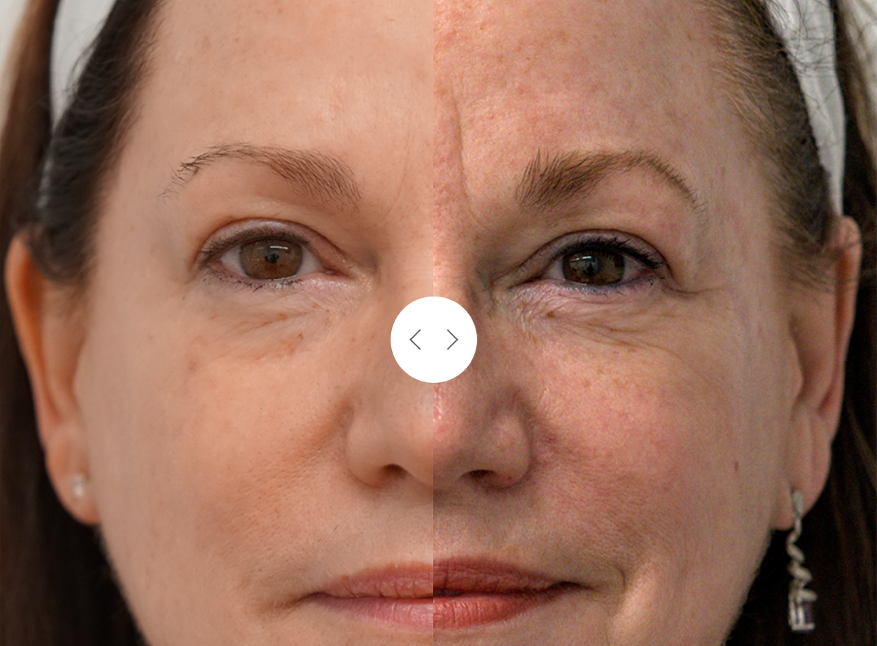 BBL HEROic Forever Young Photofacial