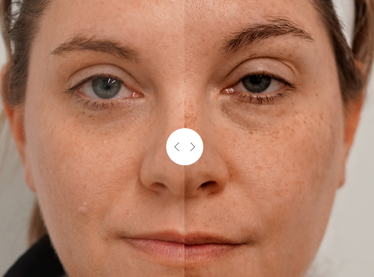 BBL HEROic Forever Young Photofacial